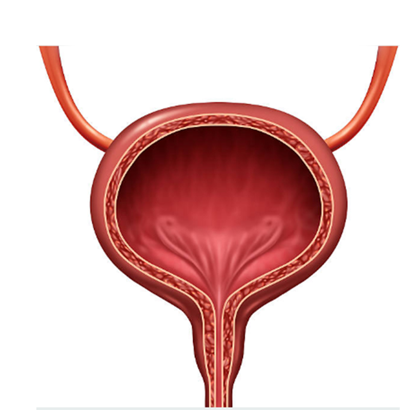 urologo en tuxtepec cirugia de cálculo vesical