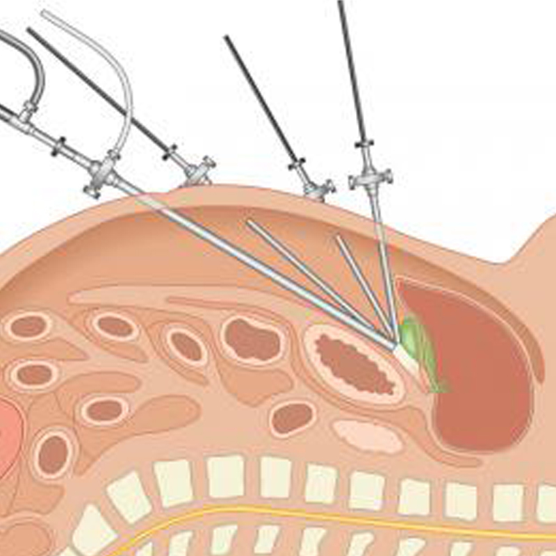urologo en tuxtepec Cirugía Laparoscópica de Urología